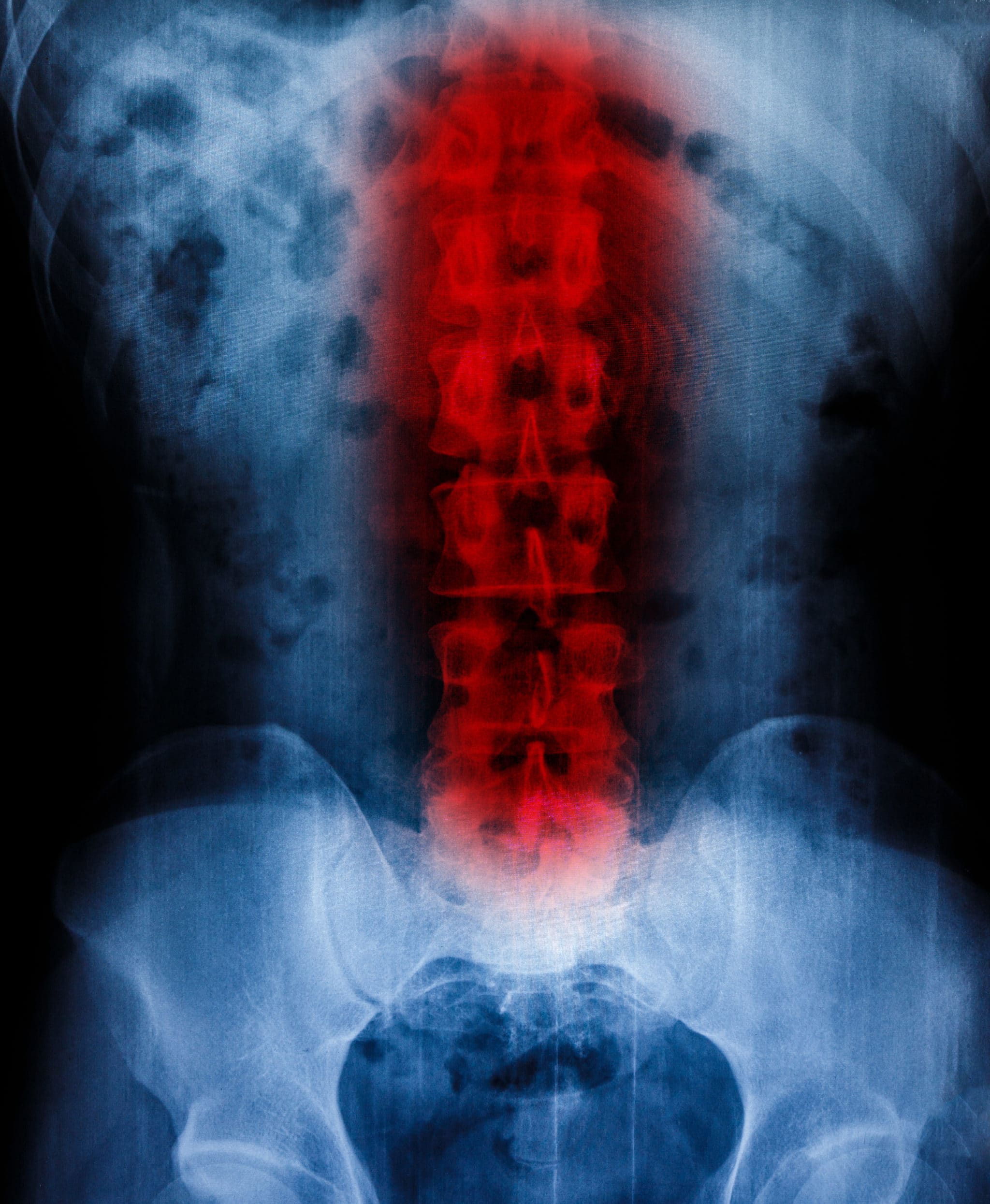 spinal cord injury